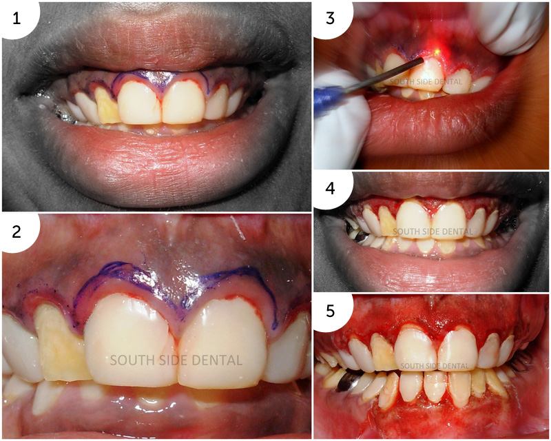Laser Assisted Gingivectomy and Depigmentation